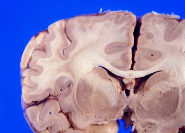 5A1 Adrenoleukodystrophy (X-ALD) Case 5 b