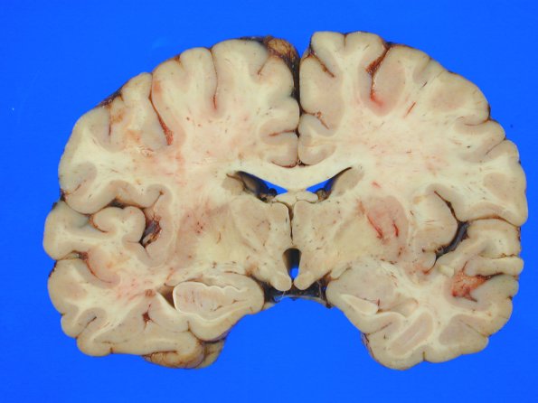 6A1 Adrenoleukodystrophy 7