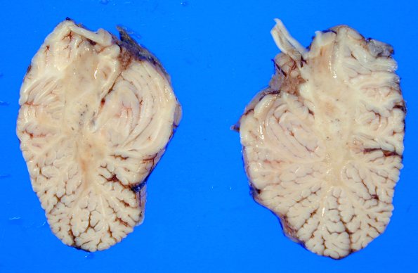 6A2 Adrenoleukodystrophy 10