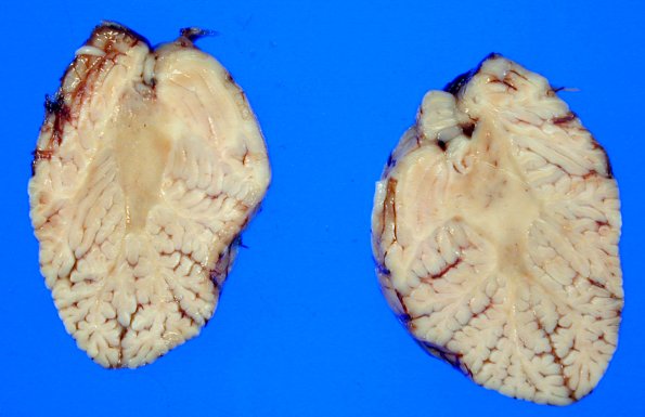 6A3 Adrenoleukodystrophy 11