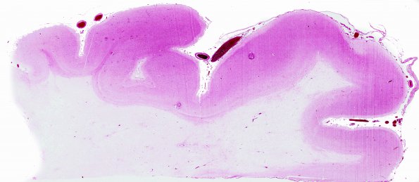 7A1 Adrenoleukodystrophy, advanced (Case7) H&E WM