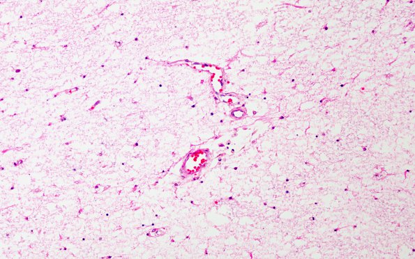 7A2 Adrenoleukodystrophy, advanced (Case 7) H&E 4