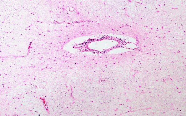 7A3 Adrenoleukodystrophy, advanced (Case 7) H&E 3