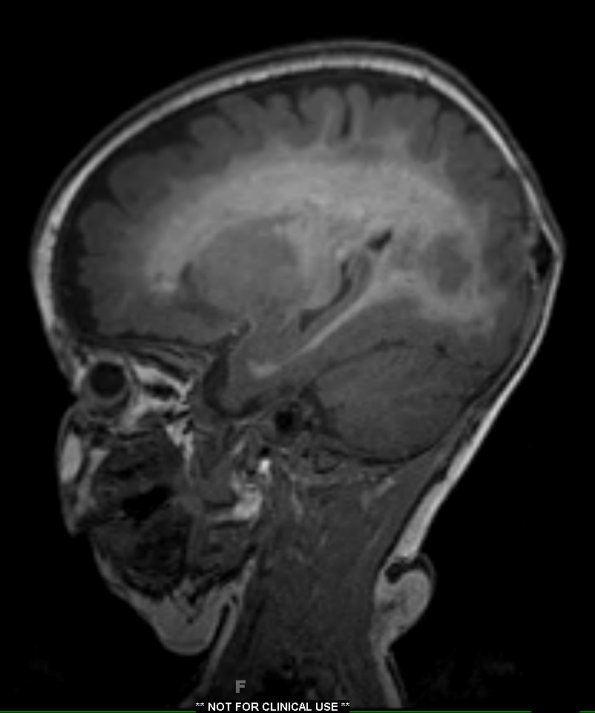 1A1 Alexander's Dz (GFAP mutation, Case 1) T1 MPRAGE 1 - Copy