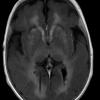 1A2 Alexander's Dz (GFAP mutation, Case 1) T1 FL2D W 3 - Copy