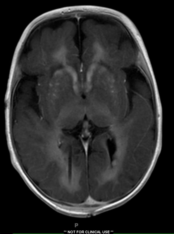 1A2 Alexander's Dz (GFAP mutation, Case 1) T1 FL2D W 3 - Copy