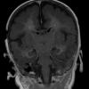 1A3 Alexander's Dz (GFAP mutation, Case 1) T1 FL2D W - Copy