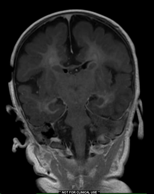 1A3 Alexander's Dz (GFAP mutation, Case 1) T1 FL2D W - Copy