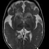 1A4 Alexander's Dz (GFAP mutation, Case 1) T2 copy - Copy