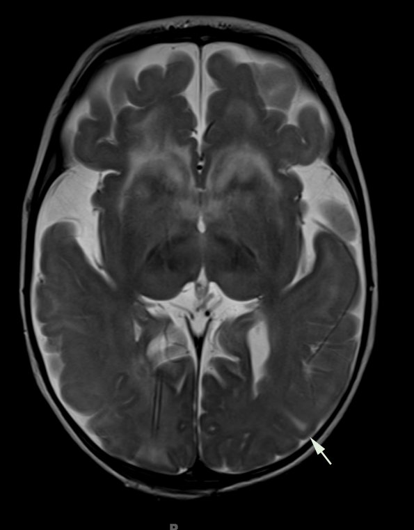 1A4 Alexander's Dz (GFAP mutation, Case 1) T2 copy - Copy