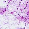 1B1 Alexander's Dz (GFAP mutation, Case 1) H&E Smear 6