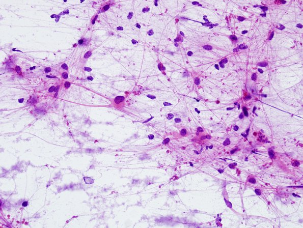 1B1 Alexander's Dz (GFAP mutation, Case 1) H&E Smear 6