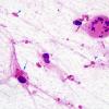 1B2 Alexander's Dz (GFAP mutation, Case 1) H&E Smear 10 Creutzfeld cell) copy