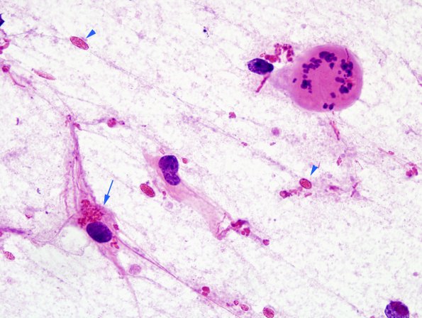 1B2 Alexander's Dz (GFAP mutation, Case 1) H&E Smear 10 Creutzfeld cell) copy