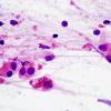 1B3 Alexander's Dz (GFAP mutation, Case 1) H&E Smear 12