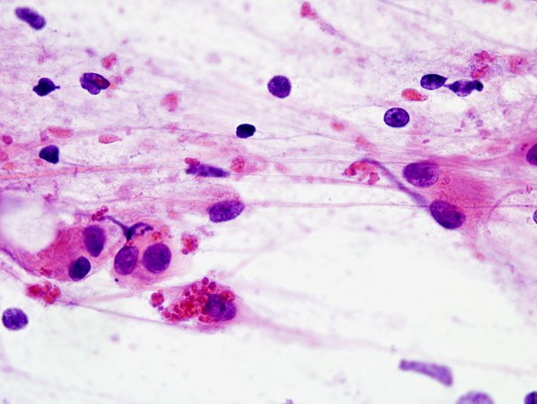 1B3 Alexander's Dz (GFAP mutation, Case 1) H&E Smear 12