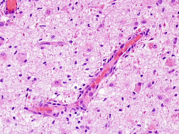 1C5 Alexander's Dz (GFAP mutation, Case 1) H&E 14