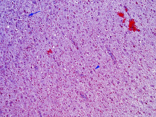 1H1 Alexander's Dz (GFAP mutation, Case 1) Trichrome 4 copy