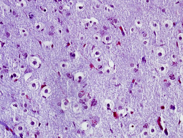 1H2 Alexander's Dz (GFAP mutation, Case 1) Trichrome 3