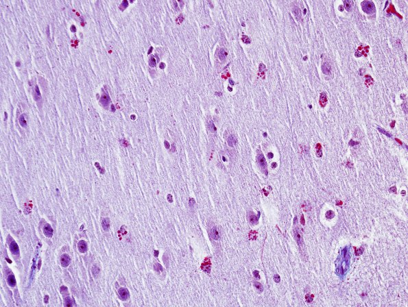 1H3 Alexander's Dz (GFAP mutation, Case 1) Trichrome 1