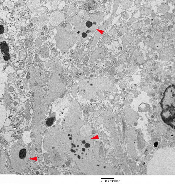 1J1 Alexander's Dz (GFAP mutation, Case 1) EM 009 copy - Copy