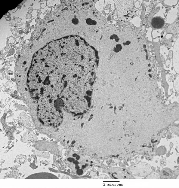 1J4 Alexander's Dz (GFAP mutation, Case 1) EM 004 - Copy