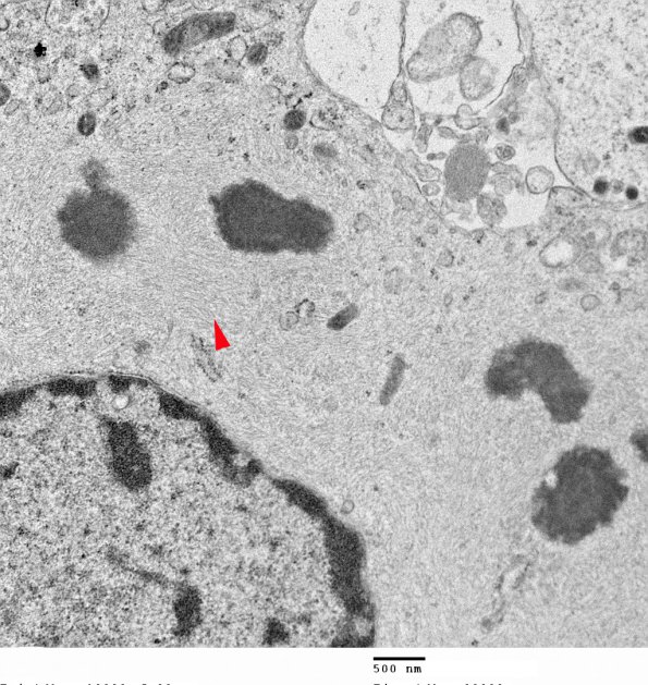 1J5 Alexander's Dz (GFAP mutation, Case 1) EM 005 copy - Copy