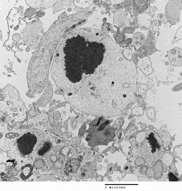 1J6 Alexander's Dz (GFAP mutation, Case 1) EM 003 - Copy