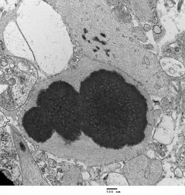 1J8 Alexander's Dz (GFAP mutation, Case 1) EM 016 - Copy