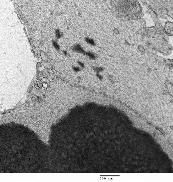 1J9 Alexander's Dz (GFAP mutation, Case 1) EM 017 - Copy