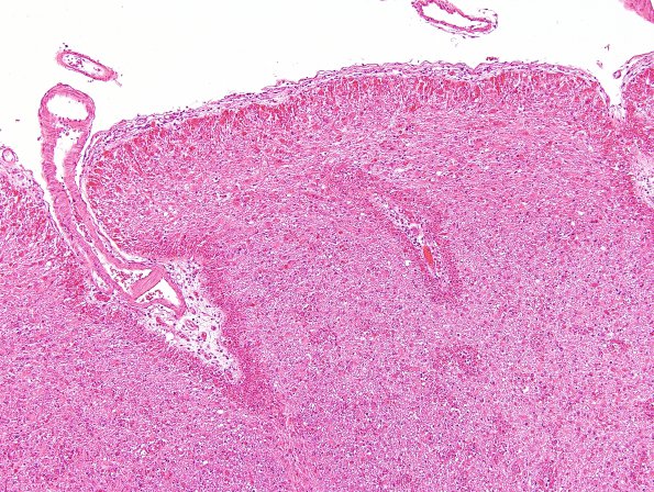 2C1 Alexander's Dz (Case 1) N5 H&E 2A