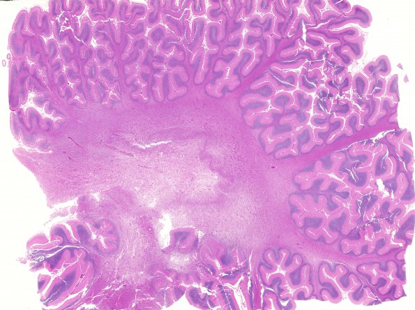 2E1 Alexander's Dz (Case 1) H&E whole mount Cerebellum