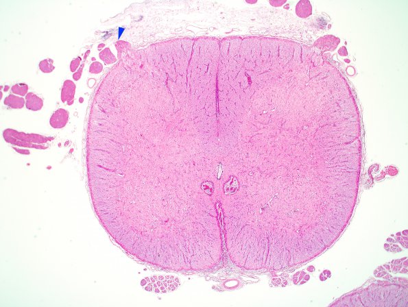 2F4 Alexander's Dz (Case 1) N10 H&E 2X 7 copy