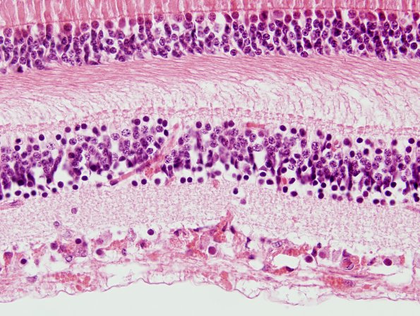 2G4 Alexander's Dz (Case 1) Eye H&E 100X 2