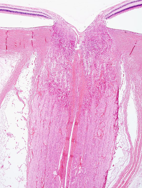 2H1 Alexander's Dz (Case 1) Eye H&E 7