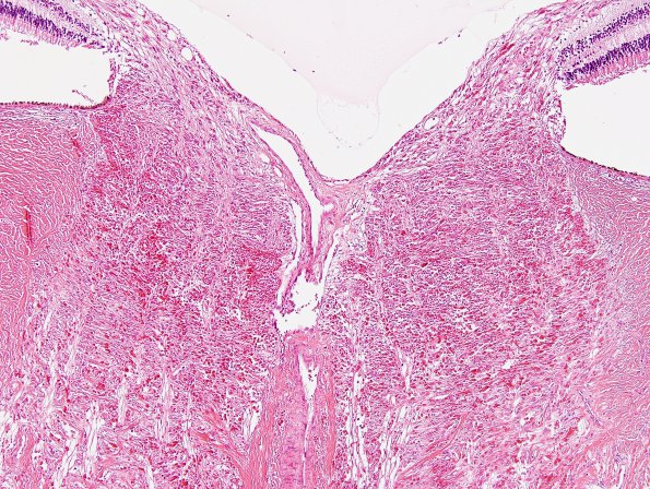 2H2 Alexander's Dz (Case 1) Eye H&E 6