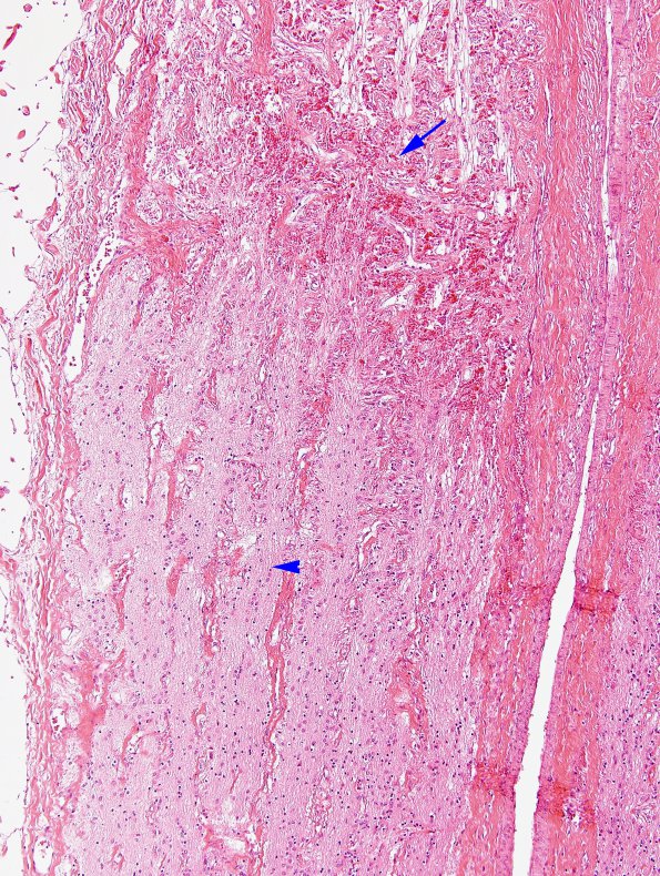 2H3 Alexander's Dz (Case 1) Eye H&E 5 copy