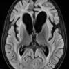 3A1 Alexander Disease (Case 3) FLAIR 2 - Copy