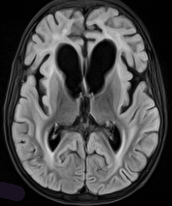 3A1 Alexander Disease (Case 3) FLAIR 2 - Copy