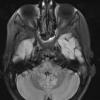 3A2 Alexander Disease (Case 3) FLAIR - Copy