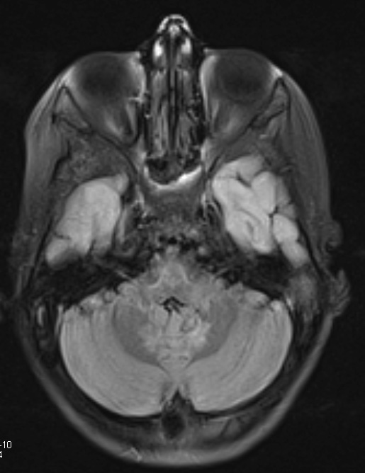 3A2 Alexander Disease (Case 3) FLAIR - Copy