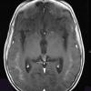 3A3 Alexander Disease (Case 3) T1 Post Contrast - Copy