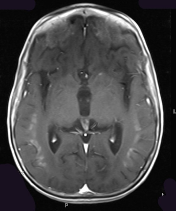 3A3 Alexander Disease (Case 3) T1 Post Contrast - Copy