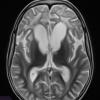 3A4 Alexander Disease (Case 3) T2 2 - Copy