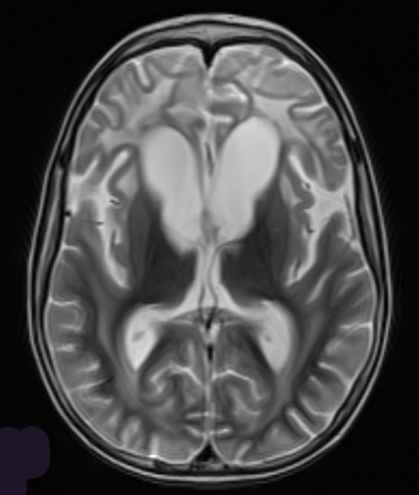 3A4 Alexander Disease (Case 3) T2 2 - Copy