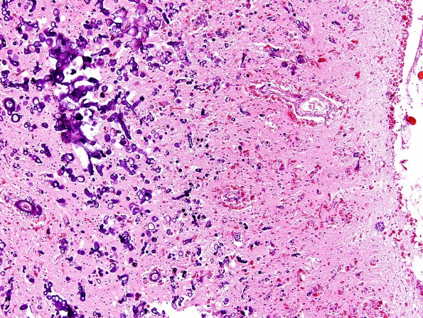 3C3 Alexander Dz (Case 3) N3 H&E 2