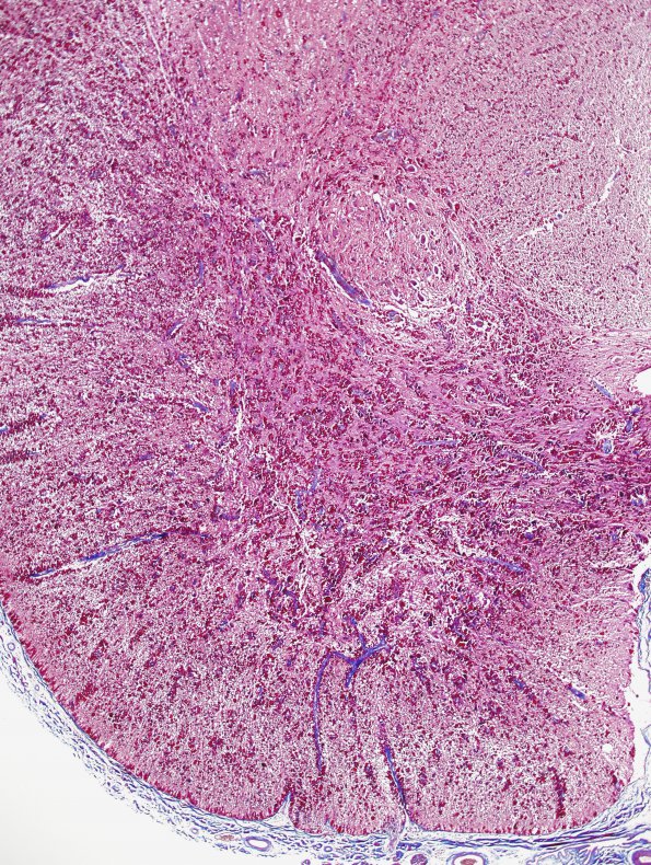 3F1 Alexander Dz (Case 3) N10 Trichrome 1