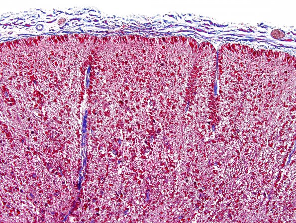 3F2 Alexander Dz (Case 3) N10 Trichrome 2