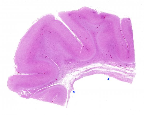 4B1 Alexander's Dz (Case 4) H&E copy