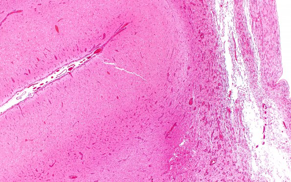 4B2 CGHA (Case 4) Cerebral cortex, little WM 4X